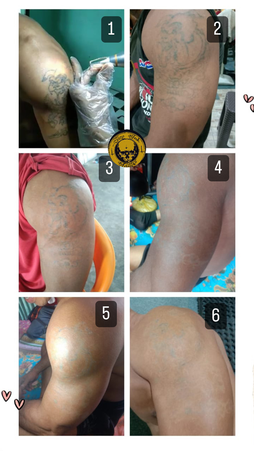 Hapus tattoo surabaya